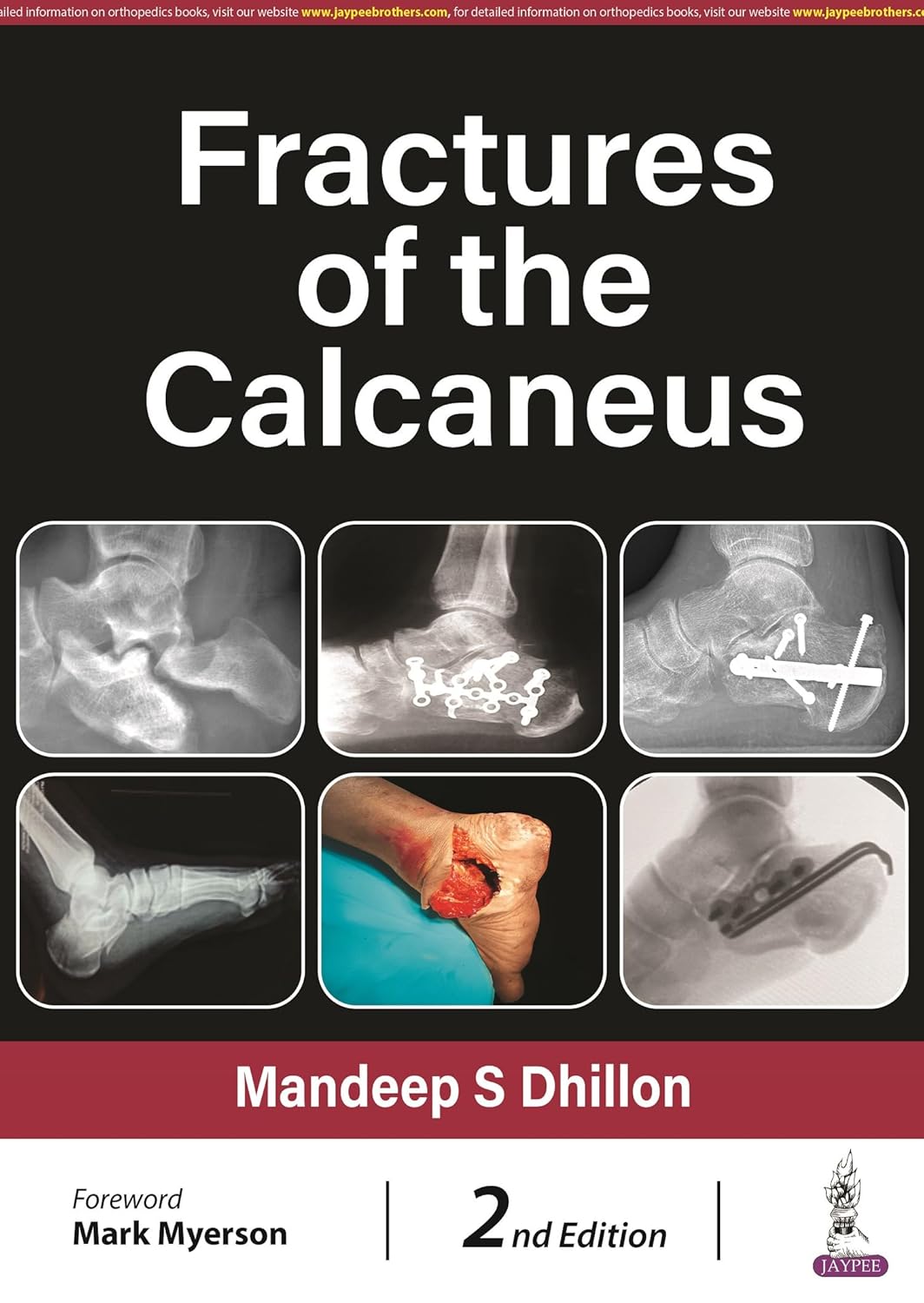 Fractures Of The Calcaneus (2nd Edition)