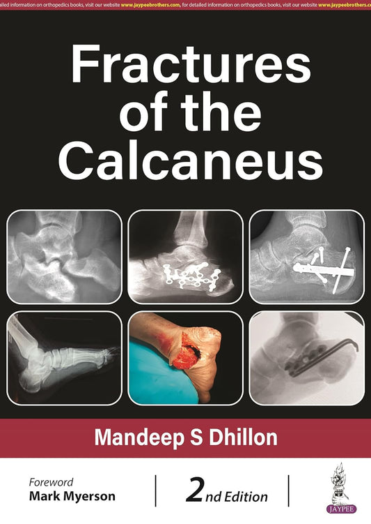 Fractures Of The Calcaneus (2nd Edition)