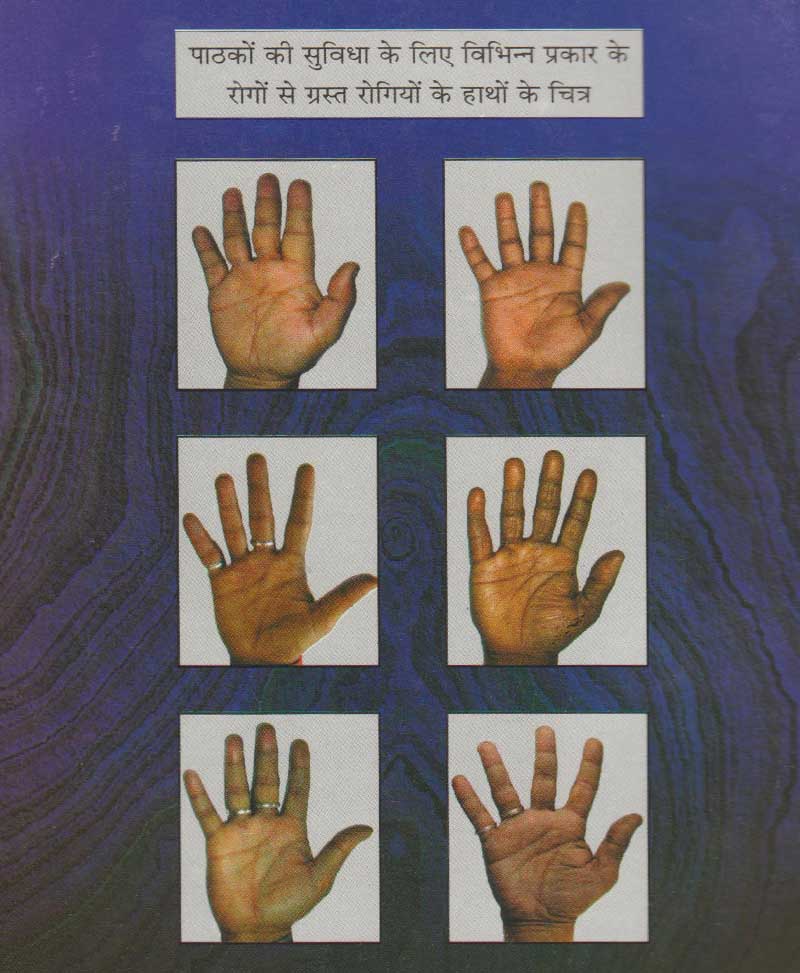 हस्तरेखाओं से रोग की पहचान मेडिकल पामिस्ट्री